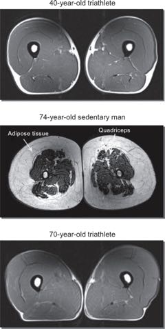 inactivity-muscle-loss-mri-images
